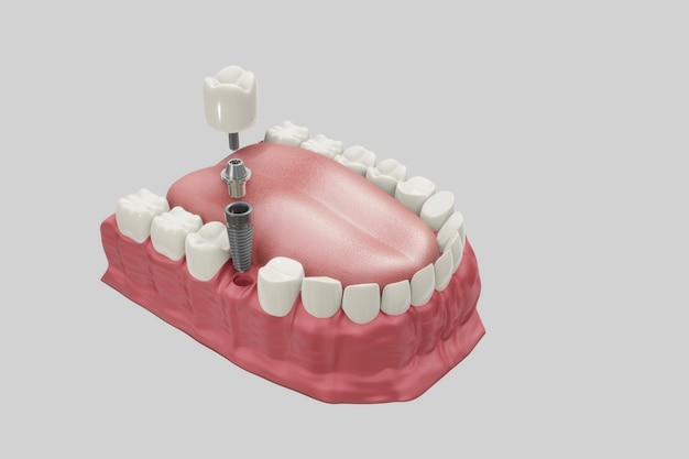 Procedura Leczenia Implantologicznego. Medycznie ścisła Koncepcja 3d Ilustracji Protez.