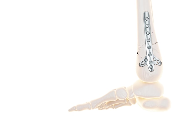 Procedura medyczna operacja osteosyntezy chirurgiczna zmiana położenia kości nóg Mocowanie złamanej kości za pomocą technologii metalowej płytki mocowanie złamania Renderowanie 3D Ilustracja 3D