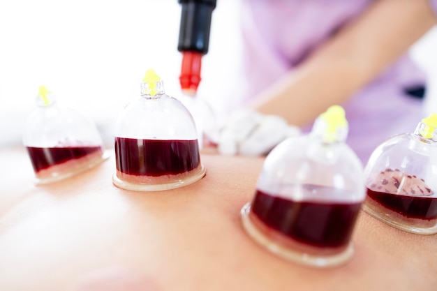 Profesjonalny terapeut używający pompy próżniowej i wykonujący leczenie hijama z kubkami wypełnionymi krwią