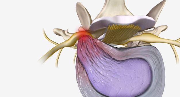 Przepuklina dysku to stan charakteryzujący się zmianami strukturalnymi krążka międzykręgowego