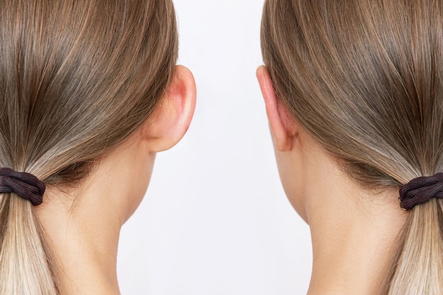 Przycięte ujęcie głowy kobiety z uszami przed i po otoplastyce Wynik plastycznej chirurgii plastycznej