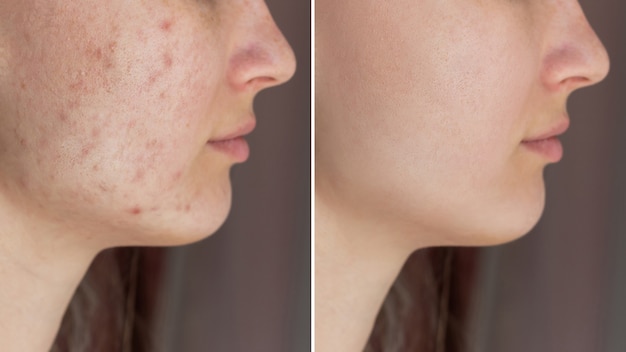 Przycięte zdjęcie twarzy młodej kobiety przed i po leczeniu trądziku na twarzy Wysypka pryszczowa na policzkach