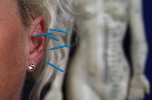 Zdjęcie przycięty obraz kobiety z igłami akupunktury na uchu