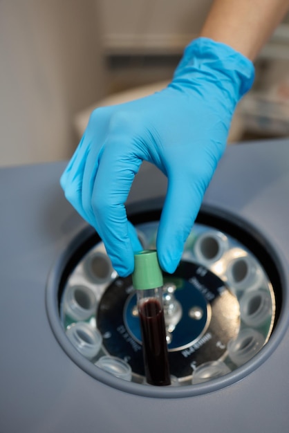 Ręce Lekarzy Kosmetyczki Wkładają Probówkę Z Krwią Do Pojemnika Wirówki Odmładzający Plazmolifting