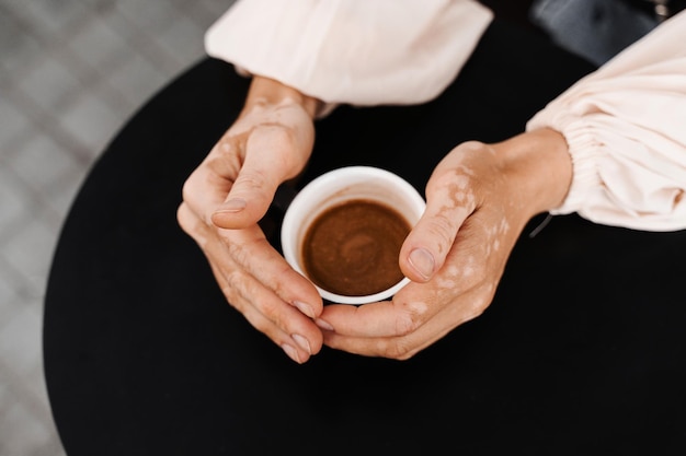 Ręce z pigmentacją skóry bielactwa trzymającego filiżankę kawy na czarnym tle zbliżenie Styl życia z sezonowymi chorobami skóry