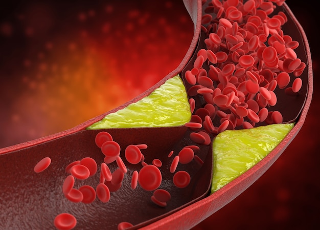 Zdjęcie rendering 3d miażdżycy z krwią cholesterolową lub blaszką miażdżycową w naczyniu powodującym chorobę wieńcową