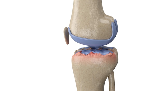 Rendering 3D zapalenia stawów kolana