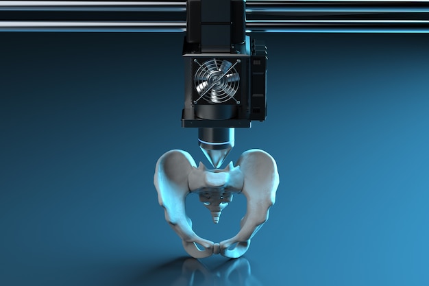 Zdjęcie renderowanie 3d drukarka 3d drukuje protezę kości biodrowej