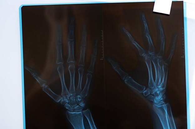 Zdjęcie rentgen ręki na szarym tle