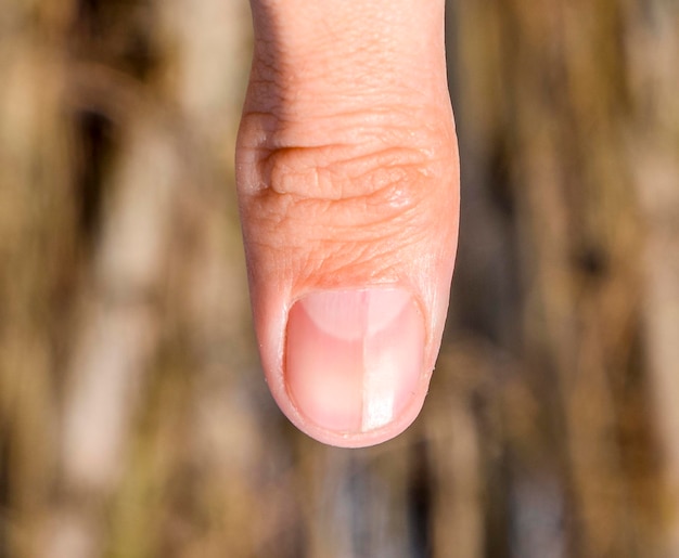 Zdjęcie rozgałęziony paznokieć na kciuku rozszerzenie paznokiecia patologia urazowa paznokieć podzielony na pół