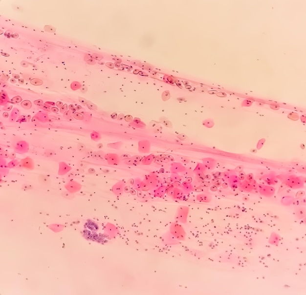 Rozmaz cytologiczny pod mikroskopem wykazujący rozmaz zapalny ze zmianami związanymi z HPV. Rak szyjki macicy