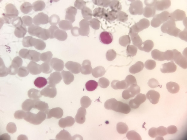 Rozmaz krwi ludzkiej pokazujący limfocyty białych krwinek.