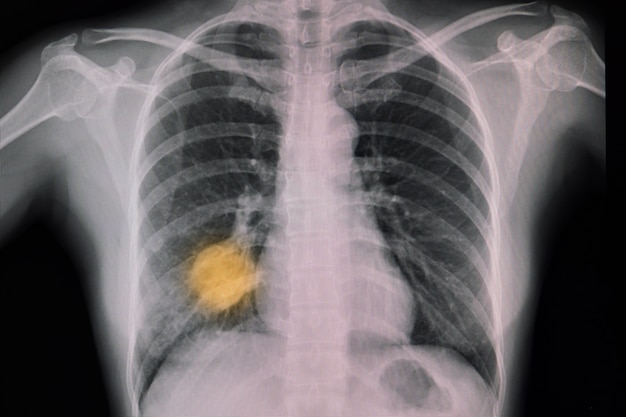 RTG klatki piersiowej pacjenta z pierwotnym guzem płuca