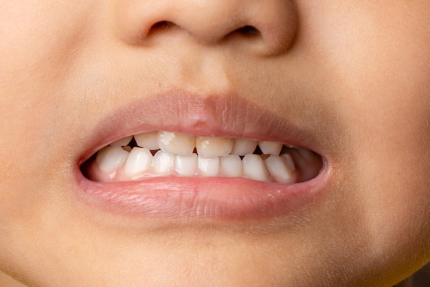 Selektywne skupienie Zbliżenie 4-latków z pierwszymi zębami mlecznymi