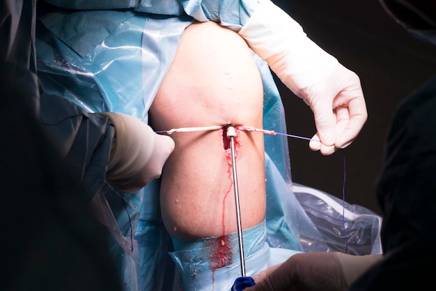 Zdjęcie Środkowa sekcja chirurgów wykonujących operację kolana w szpitalu.