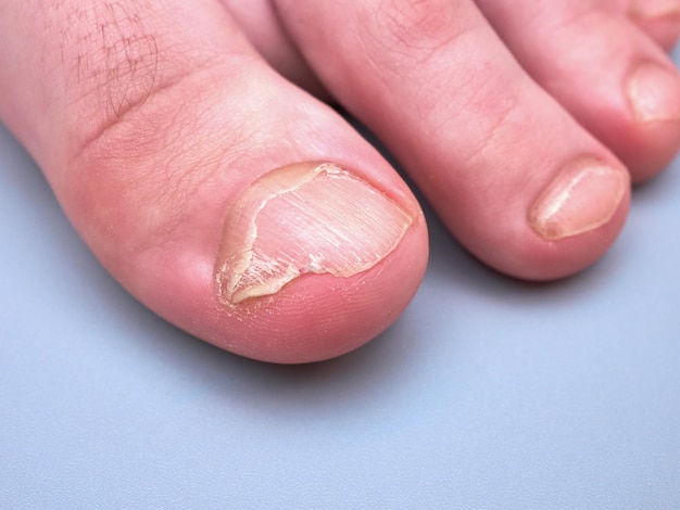 Stopa młodego chłopca ze słabymi lub łamliwymi paznokciami choroba onychoschizia na białym tle na szarym tle ekstremalny wygląd z bliska