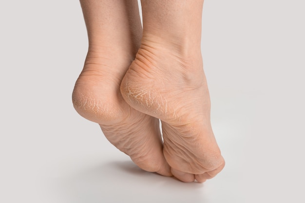 Zdjęcie stopa z suchą skórą na pięcie i podeszwie. kobiety kobiece stopy z szorstką popękaną skórą. pęknięta pięta na kobiecej stopie.