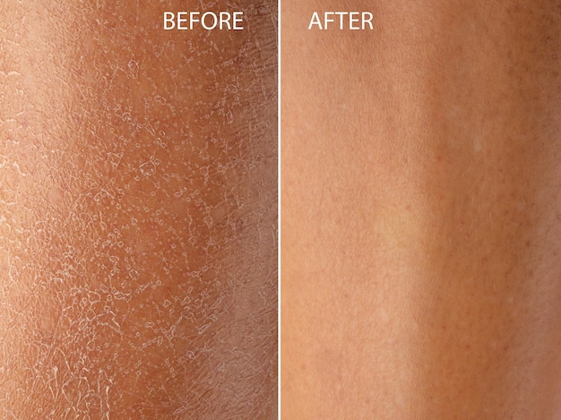 Sucha skóra przed i po zabiegu nawilżającym