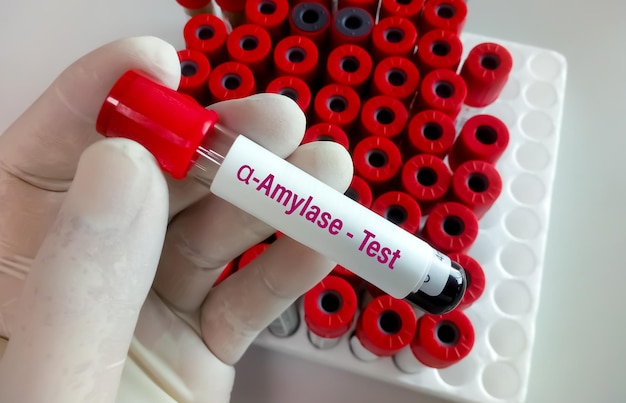 Technolog laboratoryjny przechowuje próbkę krwi do testu enzymu alfa-amylazy