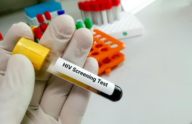 Test przesiewowy na obecność wirusa HIV w celu zdiagnozowania zakażenia wirusem HIV