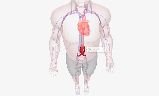 Zdjęcie tętniak aorty brzusznej występuje, gdy aorta brzuszna rozszerza się z powodu osłabienia ściany tętnicy