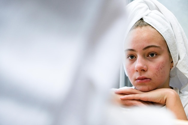 Zdjęcie trądzik smutna nastolatka problematyczna skóra u nastolatków