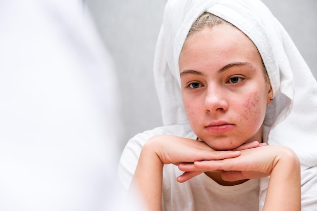 Zdjęcie trądzik. smutna nastolatka. skóra problematyczna u młodzieży.