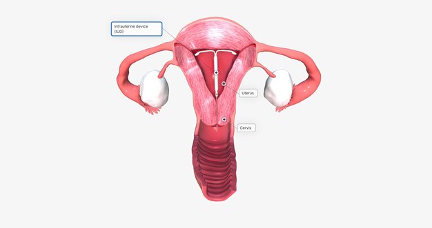 Urządzenie wewnątrzmaciczne wewnątrz fantomu macicy