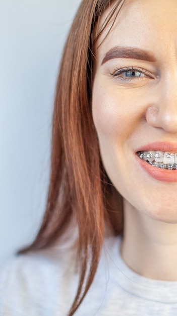 Uśmiech Młodej Dziewczyny Z Aparatem Ortodontycznym Na Białych Zębach. Prostowanie Zębów.