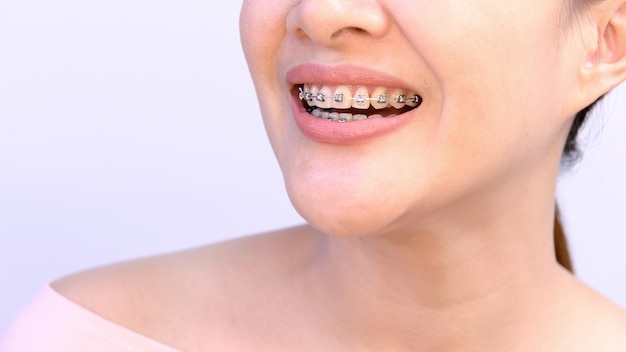 Uśmiechnięta Azjatycka Kobieta Nosi Aparat Ortodontyczny. Opieka Stomatologiczna I Zdrowe Zęby.