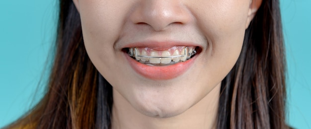 Uśmiechnięta Azjatycka Kobieta Nosi Ortodontyczny Uchwyt Na Tle Niebieskiego Ekranu. Opieka Stomatologiczna I Zdrowe Zęby.