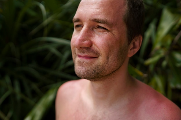 Zdjęcie widok człowieka z oparzeniami słonecznymi na plaży