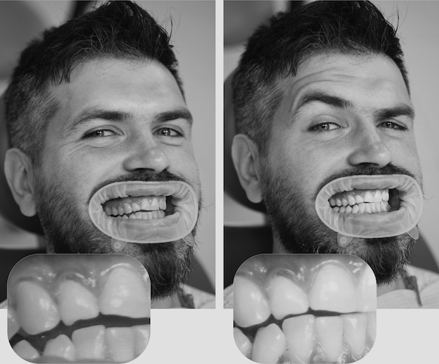Zdjęcie wybielanie po i przed mężczyzną w fotelu dentystycznym dentysta przygotowujący się do wybielania zębów