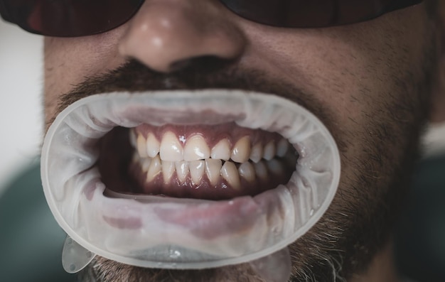 Wybielanie zębów w gabinecie stomatologicznym Podawanie środków znieczulających, aby pacjenci nie odczuwali bólu podczas zabiegów Porównanie po wybielaniu zębów Wybielanie zębów