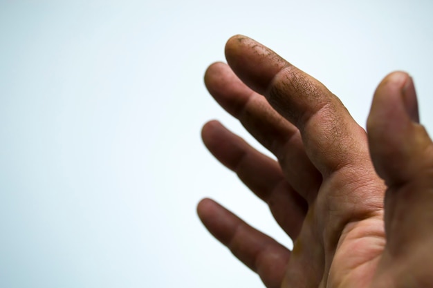 Wyjątkowo sucha, odwodniona i popękana skóra męskiej dłoni z fragmentami naskórka, które złuszczają się...