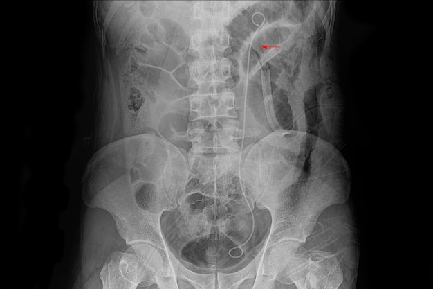 Xray film pacjenta z lewym stentem moczowodu.