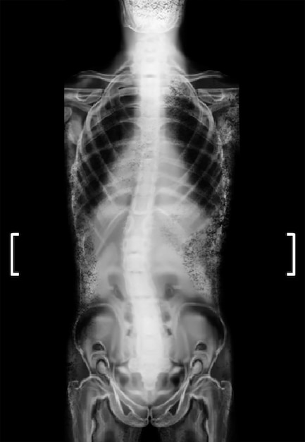 Zdjęcie xray ludzkiego kręgosłupa pokazujący krzywiznę pacjent cierpiący na skoliozę