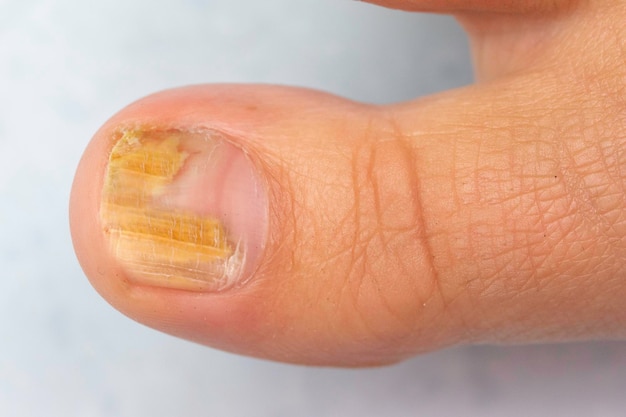 Z bliska widok paznokcia dużego palca u dorosłego białego, kruchego i zagęszczonego żółtym przebarwieniem