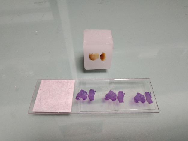 Zabarwiony preparat histologiczny gotowy do badania mikroskopowego. Cytologia. Rak, nowotwór złośliwy.