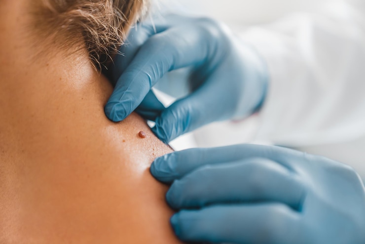 Zdjęcie zbliżenie dermatologa badającego znamię pacjenta w klinice