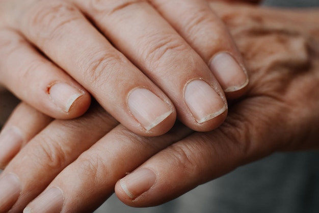 Zbliżenie dłoni starszej kobiety rasy kaukaskiej uszkodzone paznokcie i suchą skórę wisiorki i skórki Choroby skóry Dermatologia Fotografia makro Selektywny fokus