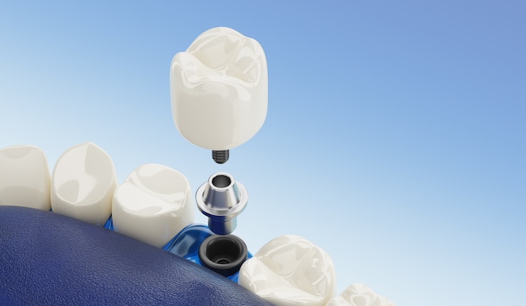 Zdjęcie zbliżenie element implantów dentystycznych przezroczysty. renderowanie 3d.