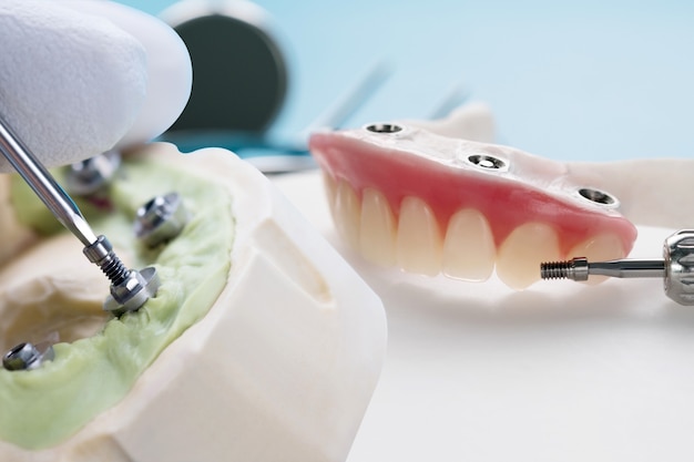 Zbliżenie / Elementy łącznika wymiennego / Łącznik tymczasowy implantu dentystycznego / Implant śrubowy łącznika.