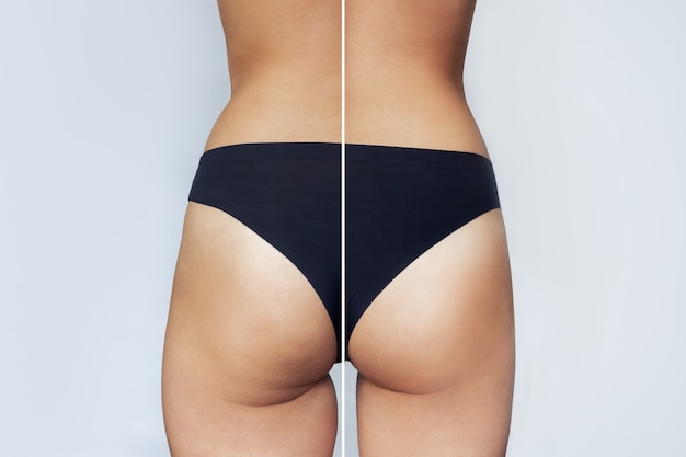 Zbliżenie kobiecych pośladków przed i po zabiegu liposukcji lub zabiegu antycellulitowego Sporty dietetyczne