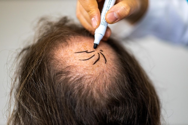Zbliżenie kobiecych rąk pracujących nad przygotowaniem do przeszczepu włosów na głowie mężczyzny