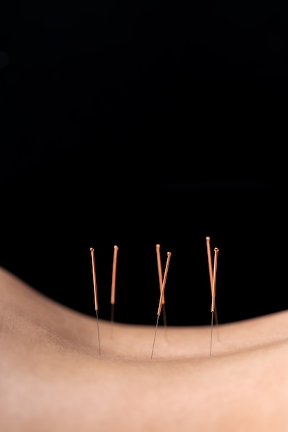 Zbliżenie Kobiety Z Powrotem Ze Stalowymi Igłami Podczas Zabiegu Terapii Akupunktury