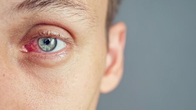Zdjęcie zbliżenie na czerwone oko mężczyzny dotkniętego infekcją, skopiuj miejsce