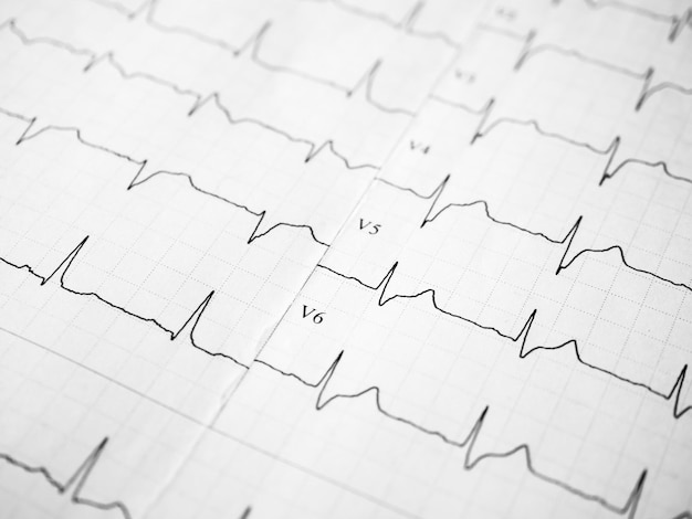 Zdjęcie zbliżenie na elektrokardiogram w formie papierowej ekg lub ekg, na którym widać bicie serca