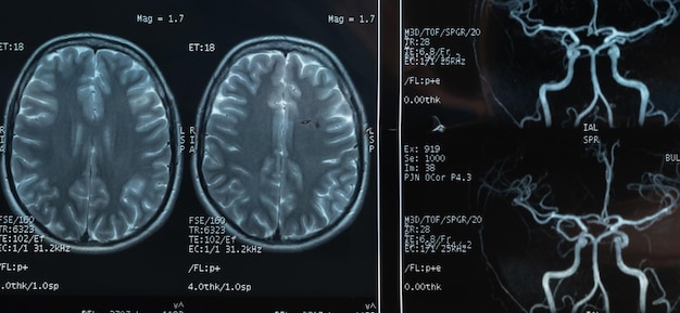 Zdjęcie zbliżenie na mri mózgu i naczyń krwionośnych osoby z silnymi bólami głowy