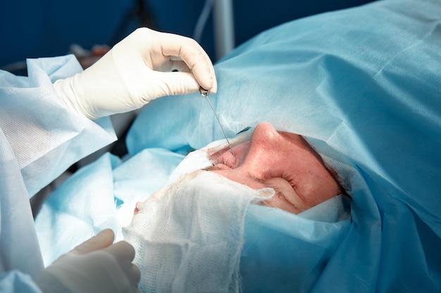 Zbliżenie na twarz pacjenta poddawanego blefaroplastyce Chirurg przecina powiekę i wykonuje manipulacje za pomocą narzędzi medycznych